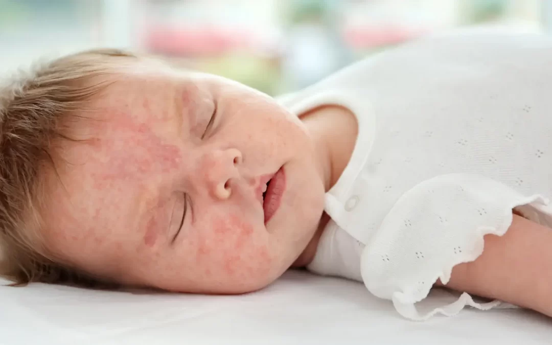 Eczema